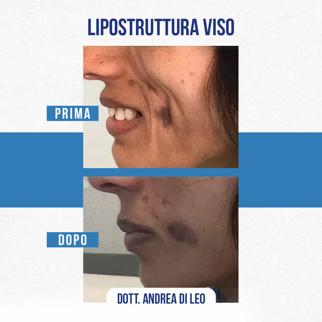 IMG-LIPOSTRUTTURA-VISO