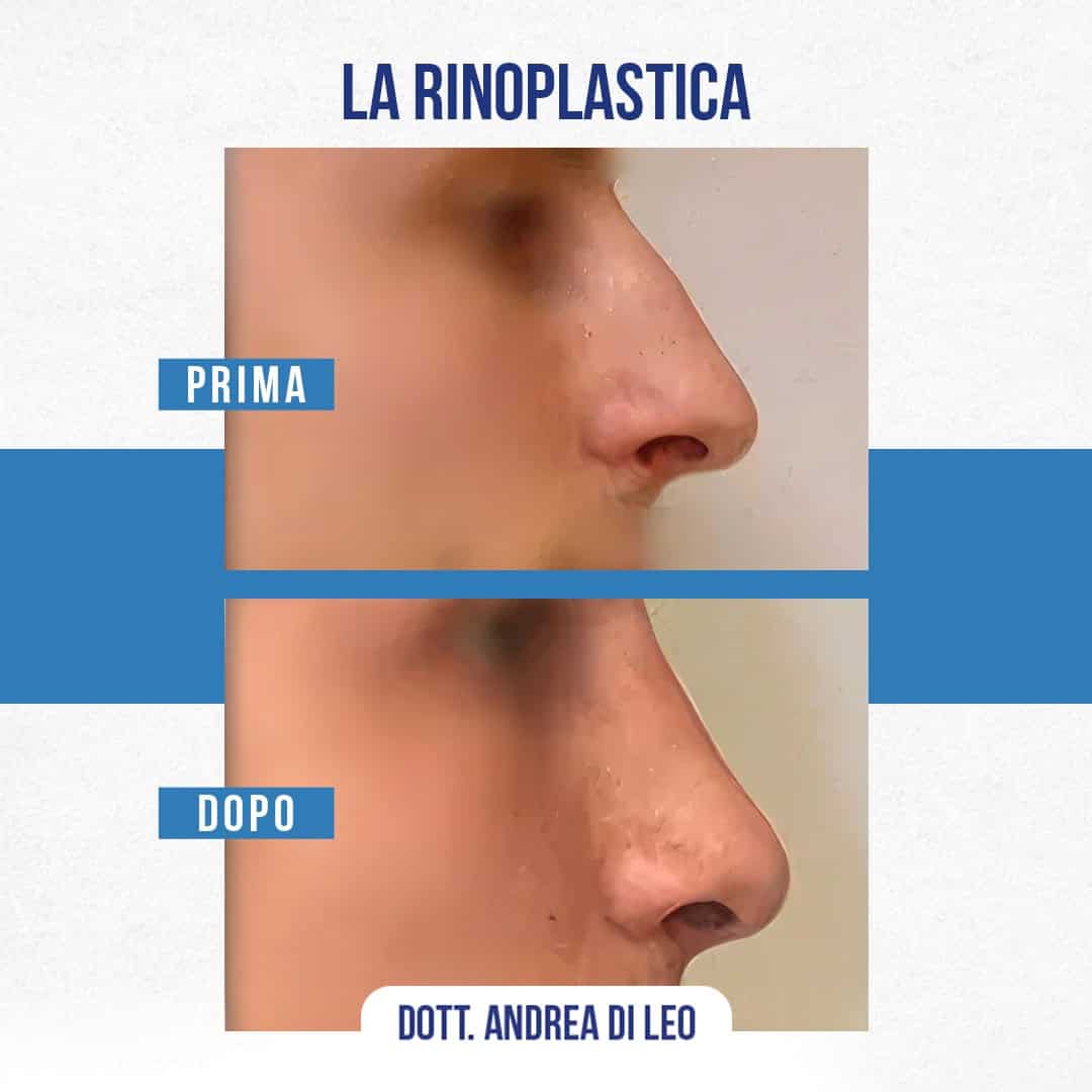 Img-Prima-Dopo-RINOPLASTICA-03