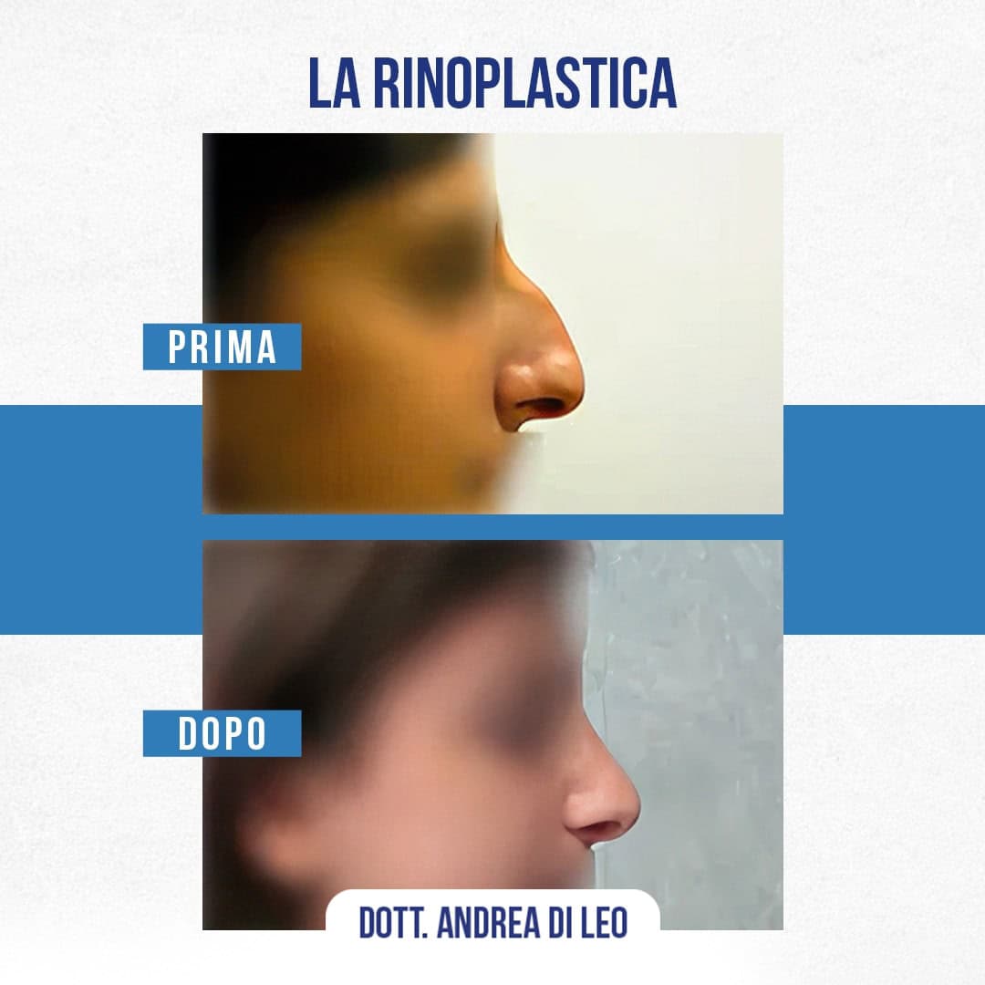Img-Prima-Dopo-RINOPLASTICA-06