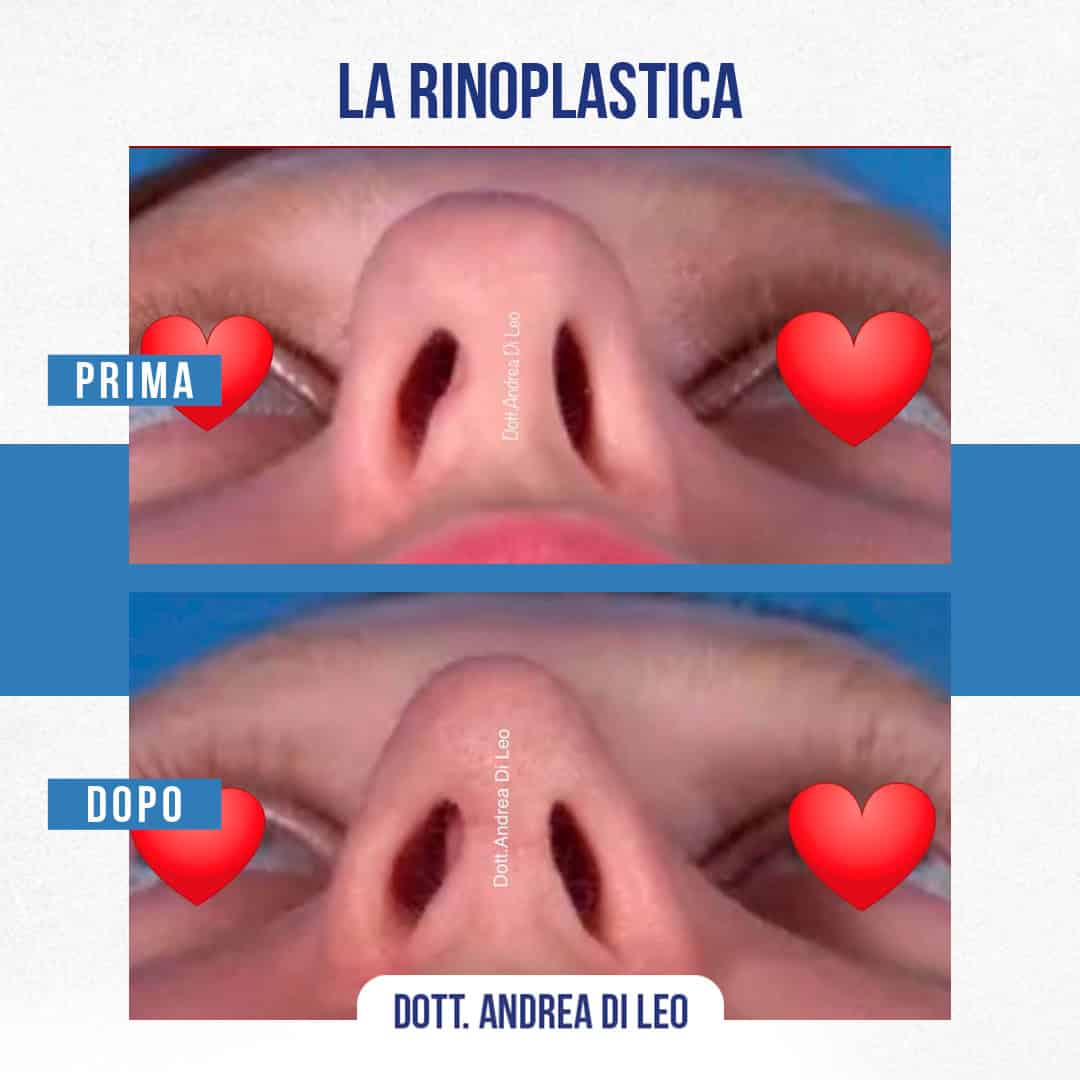 Img-Prima-Dopo-RINOPLASTICA-11