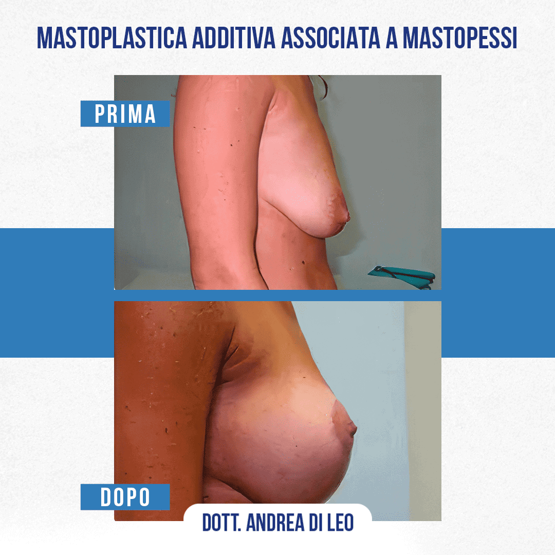 Img-prim-dop-MASTOPLASTICA ADDITIVA ASSOCIATA A MASTOPESSI-5