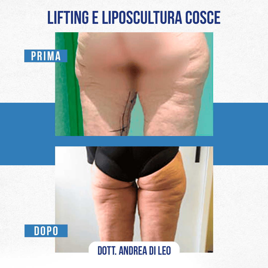 LIFTING E LIPOSCULTURA COSCE-01
