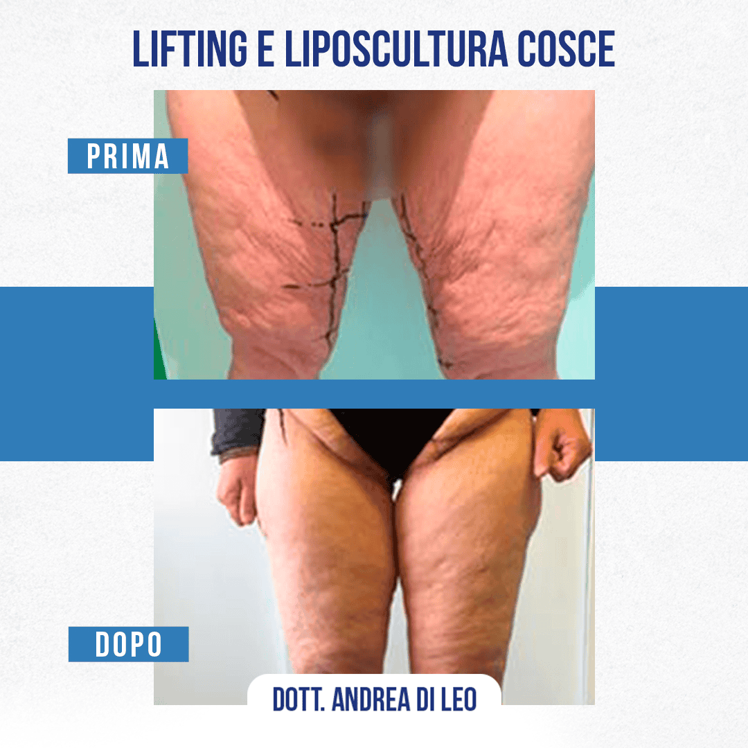 LIFTING E LIPOSCULTURA COSCE-02