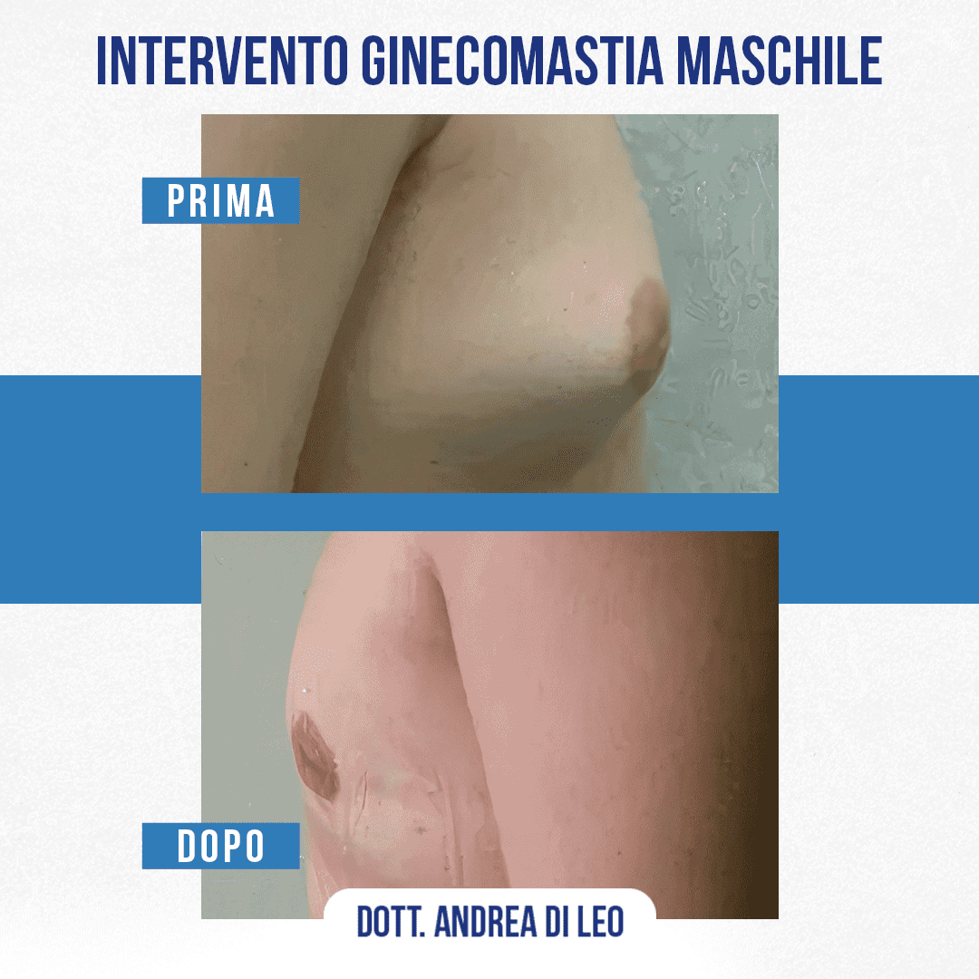 img-prim-dop-INTERVENTO GINECOMASTIA MASCHILE-2
