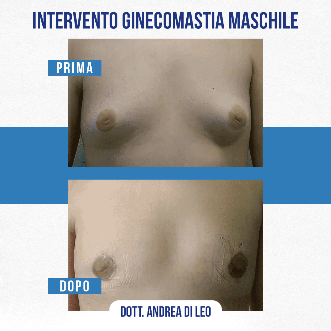 img-prim-dop-INTERVENTO GINECOMASTIA MASCHILE-3