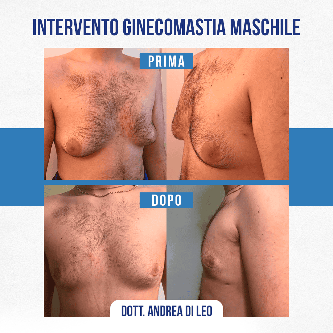 img-prim-dop-INTERVENTO GINECOMASTIA MASCHILE-5