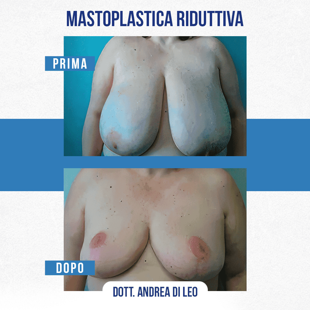 img-prim-dop-MASTOPLASTICA RIDUTTIVA-7