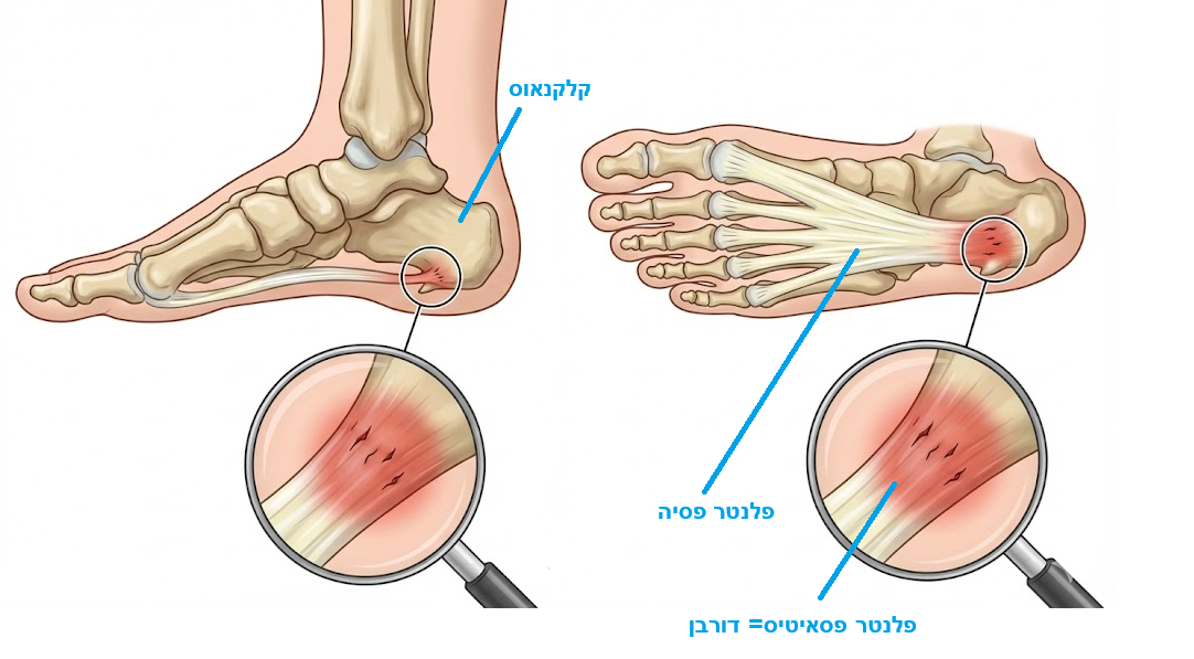 ביומכניקה של החיתולית הכפית וכאב דורבן