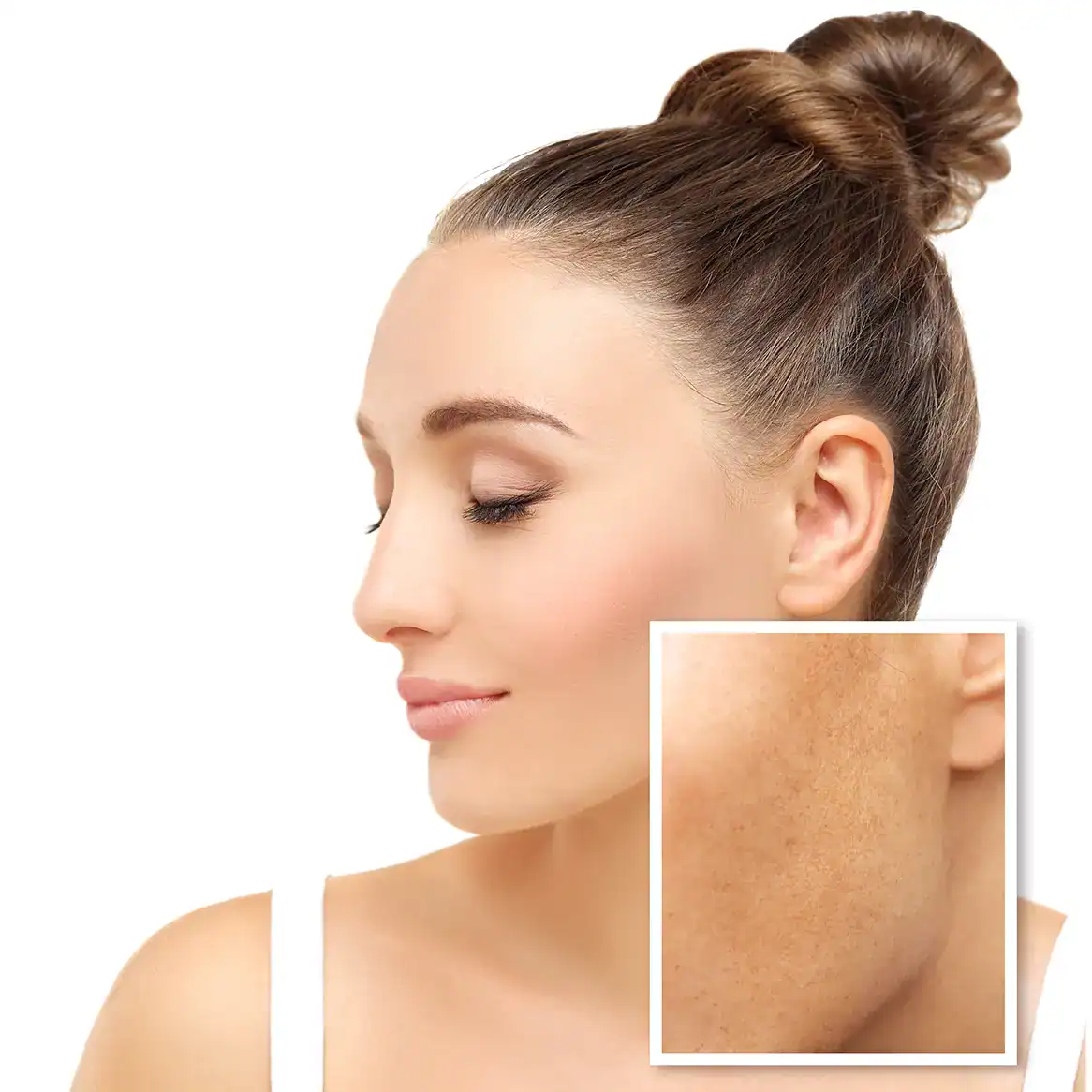 Woman with beautiful skin with a photo over her cheek to show what her hyperpigmentation used to look like