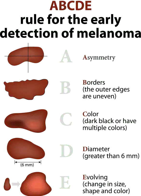 ABCDE Rule for mole check for early detection of melanoma graphic