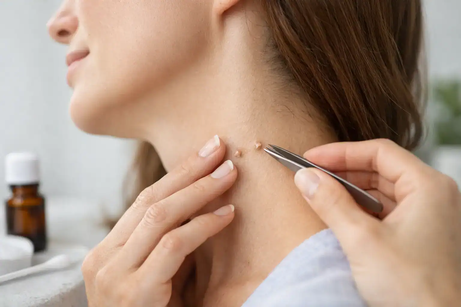 How to Remove Skin Tags Safely