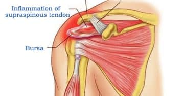 Supraspinatus Tendinosis