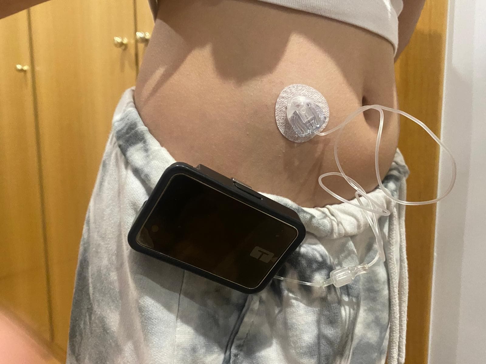 Circular adhesive medical sensor on the lower abdomen with a tubing line leading away; a smartphone rests on the clothing nearby as part of a monitoring setup.