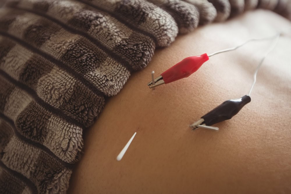 Close-up of acupuncture on bare skin with a small needle, red and black clips attached to wires, and a white Q-tip nearby, partially covered by a brown towel edge.