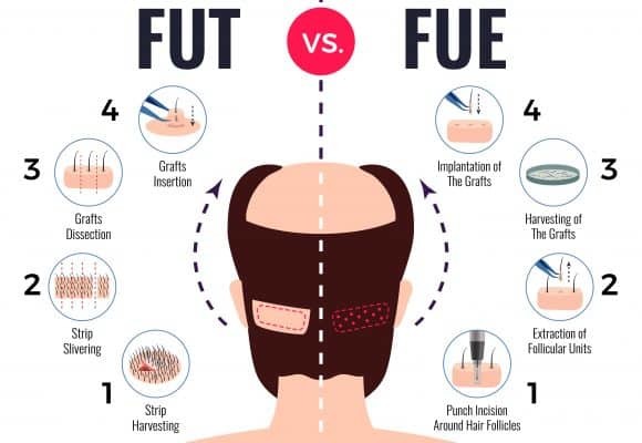 hair_transplant_guide