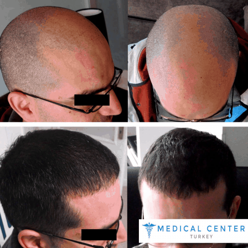 The Ultimate Hair Transplant Guide in Turkey