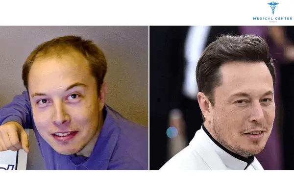 Best Hair Transplant Turkey- Medical Center Turkey