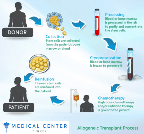 Bone marrow transplantation in Turkey