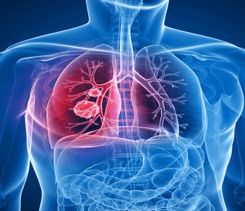 lung cancer treatment in turkey