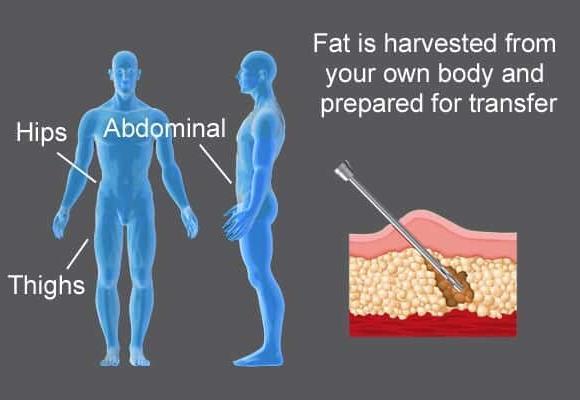 penis enlargement surgery