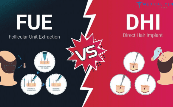 DHI _vs_FUE_Hair Transplant_Procedures