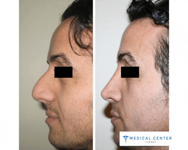 Rhinoplasty Surgery Reviews in Turkey