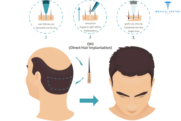 DHI vs. FUE: Hair Transplant Procedures