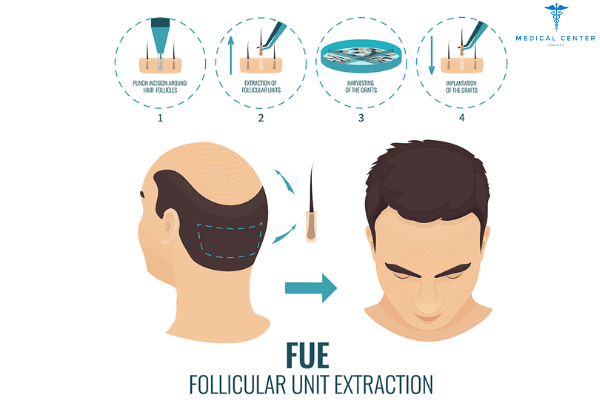 DHI vs. FUE: Hair Transplant Procedures
