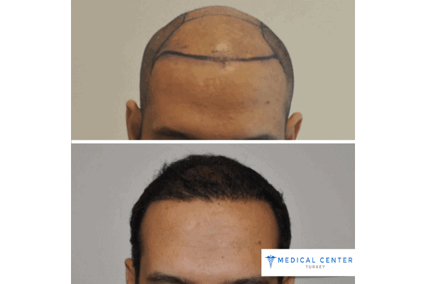 DHI vs. FUE: Hair Transplant Procedures