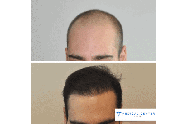 DHI vs. FUE: Hair Transplant Procedures