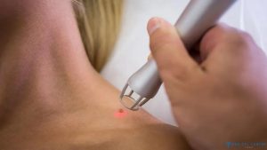 What is the cost of mole removal in Turkey 7