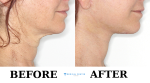 neck lift cost in turkey