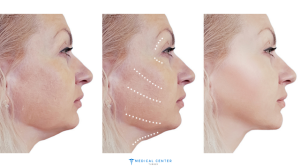 neck lift cost in turkey 2