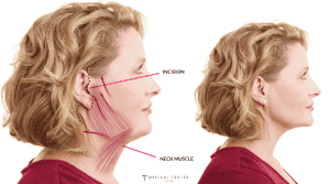 ıs neck lift painful