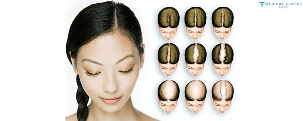 Unshaven and Painless Hair Transplantation for women