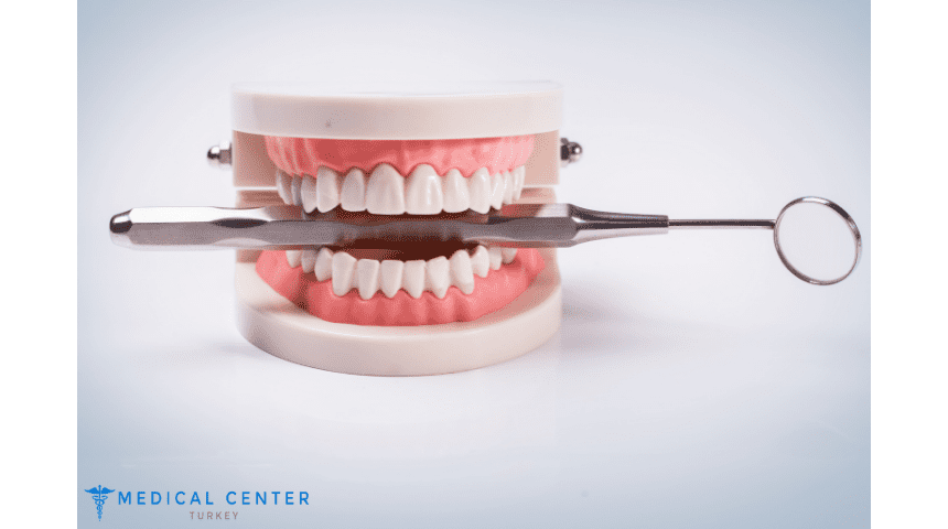 The Complete Guide to Veneers in Turkey The Complete Guide to Veneers in Turkey