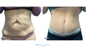 Tummy Tuck Cost 3