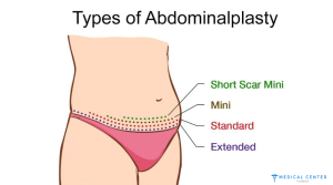 Tummy Tuck Cost 5