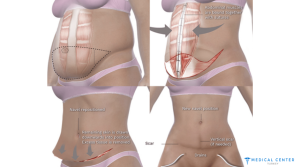 Tummy Tuck Cost 7