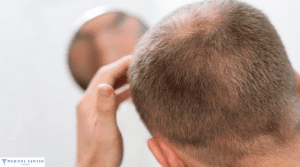 Hair Transplant Cost UK