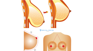 Breast Lift Cost in Turkey 3