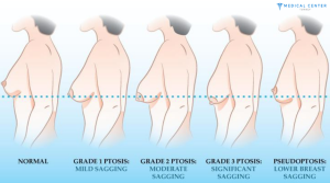 Breast Lift Cost in Turkey 4