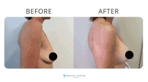 Breast Lift Cost in Turkey7