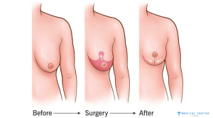 Breast Lift Costs in Turkey 1