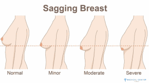 Breast Lift Costs in Turkey