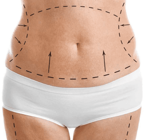 tummy tuck in turkey