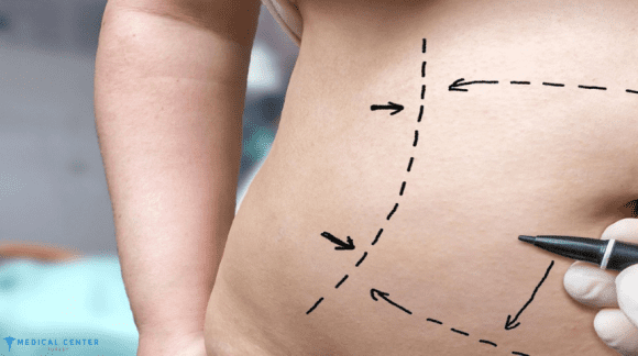 tummy tuck in turkey