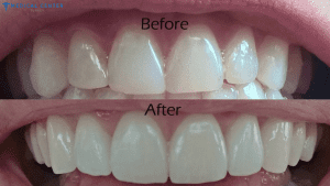 veneers-cost-in-turkey
