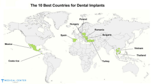 10 countries for Dental implants 1