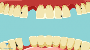 Advantages and Disadvantages of Veneers